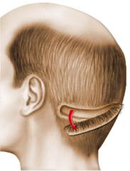 Micro Greffes Micro Greffes