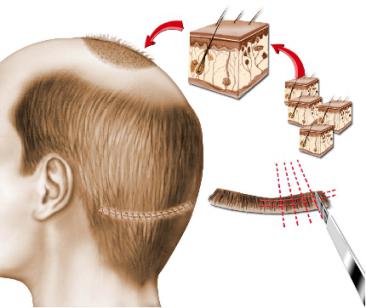 Micro Greffes Micro Greffes