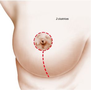 Réduction mammaire 2 cicatrices